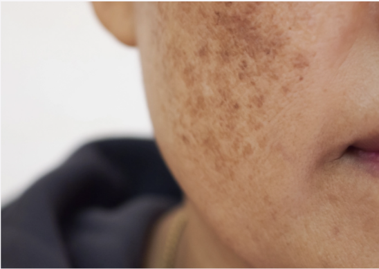 Close-up image of facial skin showing hyperpigmentation and uneven complexion | Stephanie Ho Dermatology